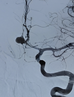 Brain Tumor Specialist india
