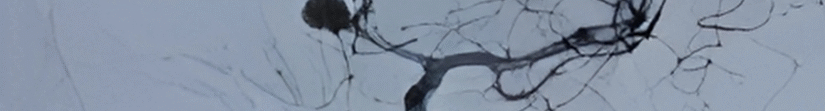 Brain Tumor Specialist india